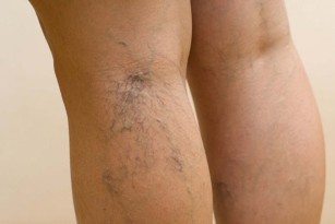 Second stage of varicose veins