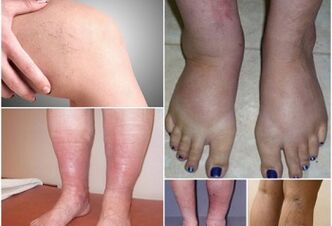 Pictures of varicose veins manifestations