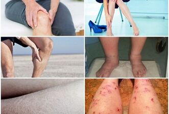 Symptoms of vein with varicose legs