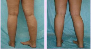 how the first stage varicose veins manifest