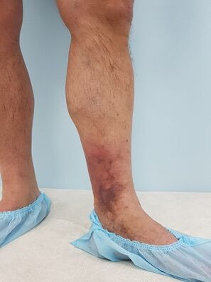 Complications from varicose veins in men