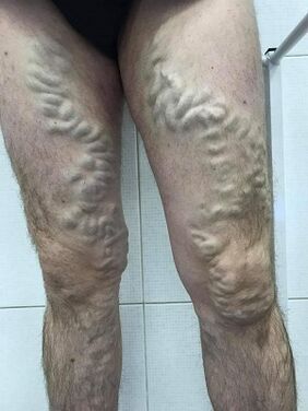 male neglected varicose veins
