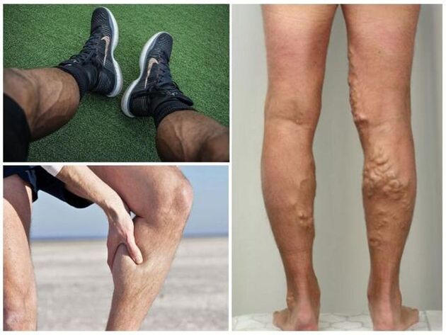 what do varicose veins look like in men's legs