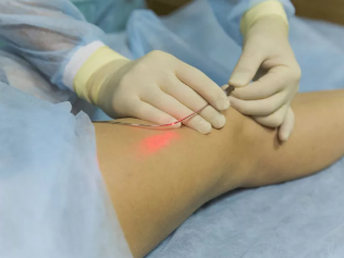 Treatment of varicose veins with laser