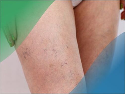 The vascular network in the leg is one of the symptoms of varicose veins