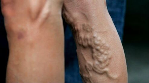 Manifestations of veins with advanced varicose veins of the lower extremities