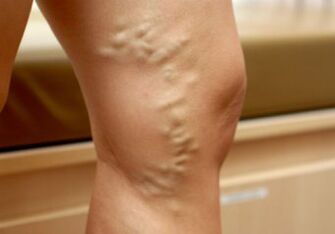 Different veins in a woman's legs