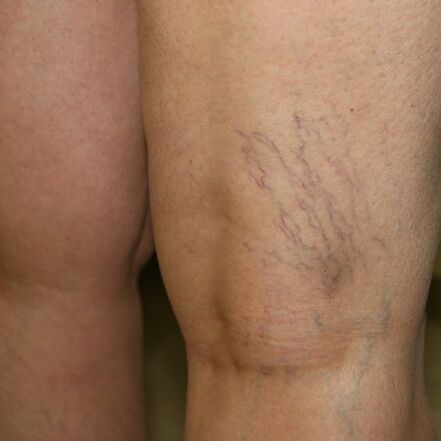 The venous network in the lower extremities is a sign of varicose veins