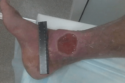 Varicose veins complications