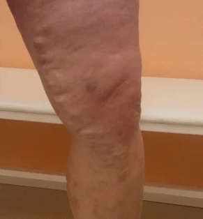varicose veins