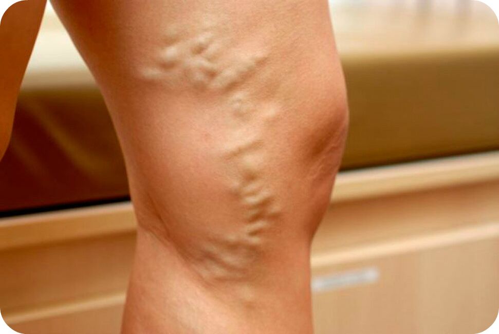 Veins with varicose veins