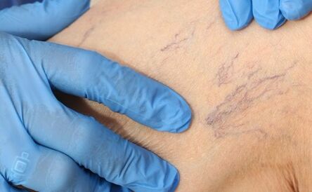 The symptoms of varicose veins