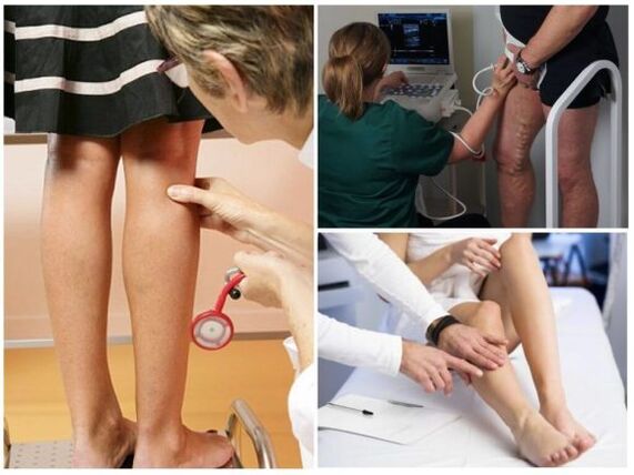 Diagnosis of varicose veins