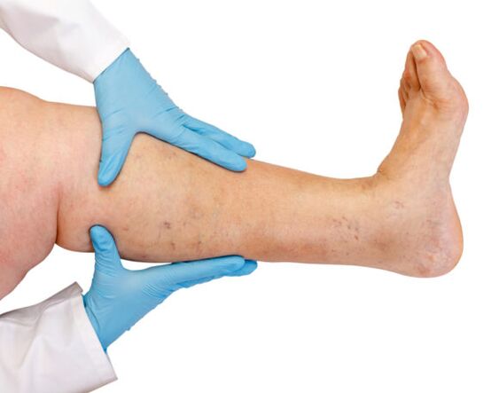 Varicose veins in the legs