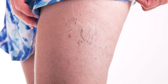 Preventing veins with varicose
