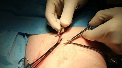 Flebectomy for varicose veins