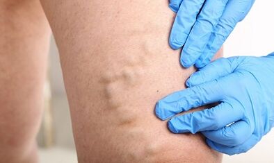 Varicose veins in the legs