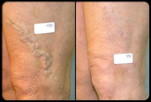 Before and after surgery in veins