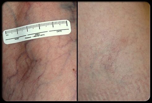 Before and after the laser therapy procedure