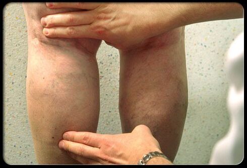 The doctor examines the legs with the varicose veins
