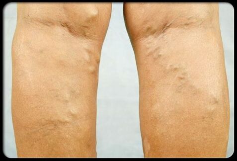 Varicose veins in the legs