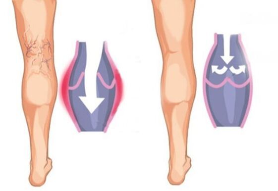 How the varicose veins look like