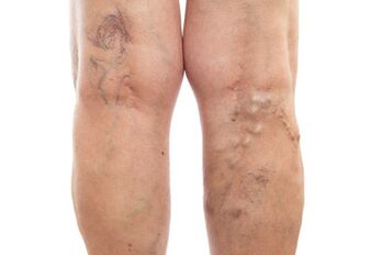varicose veins of the lower extremities